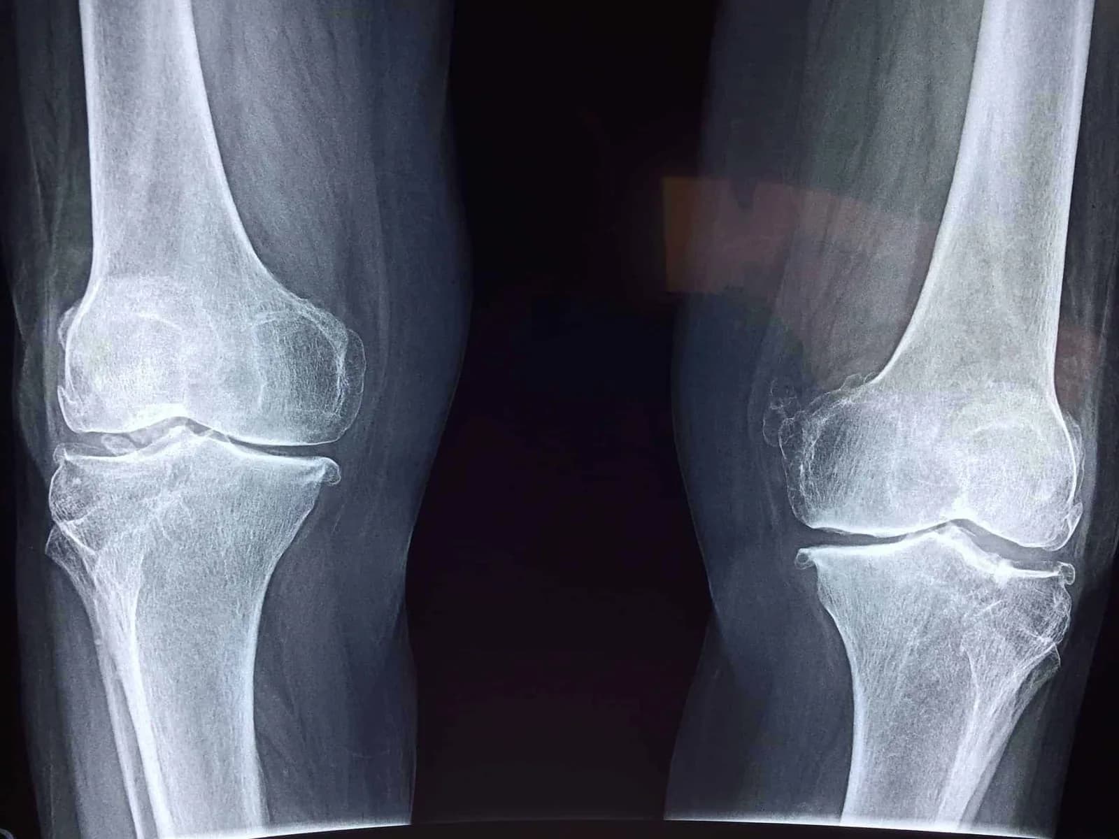 Knee Injuries and the Benefits of Chiropractic
