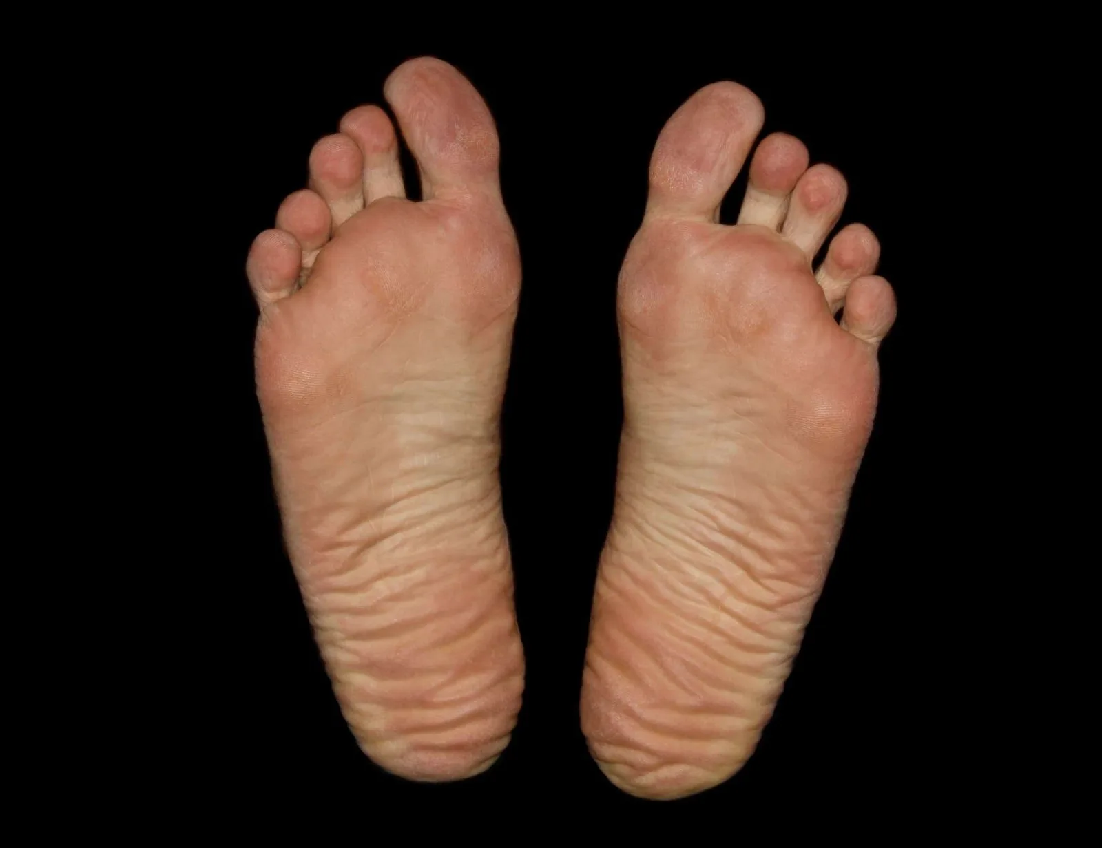 How Long Is Recovery From Plantar Fasciitis?