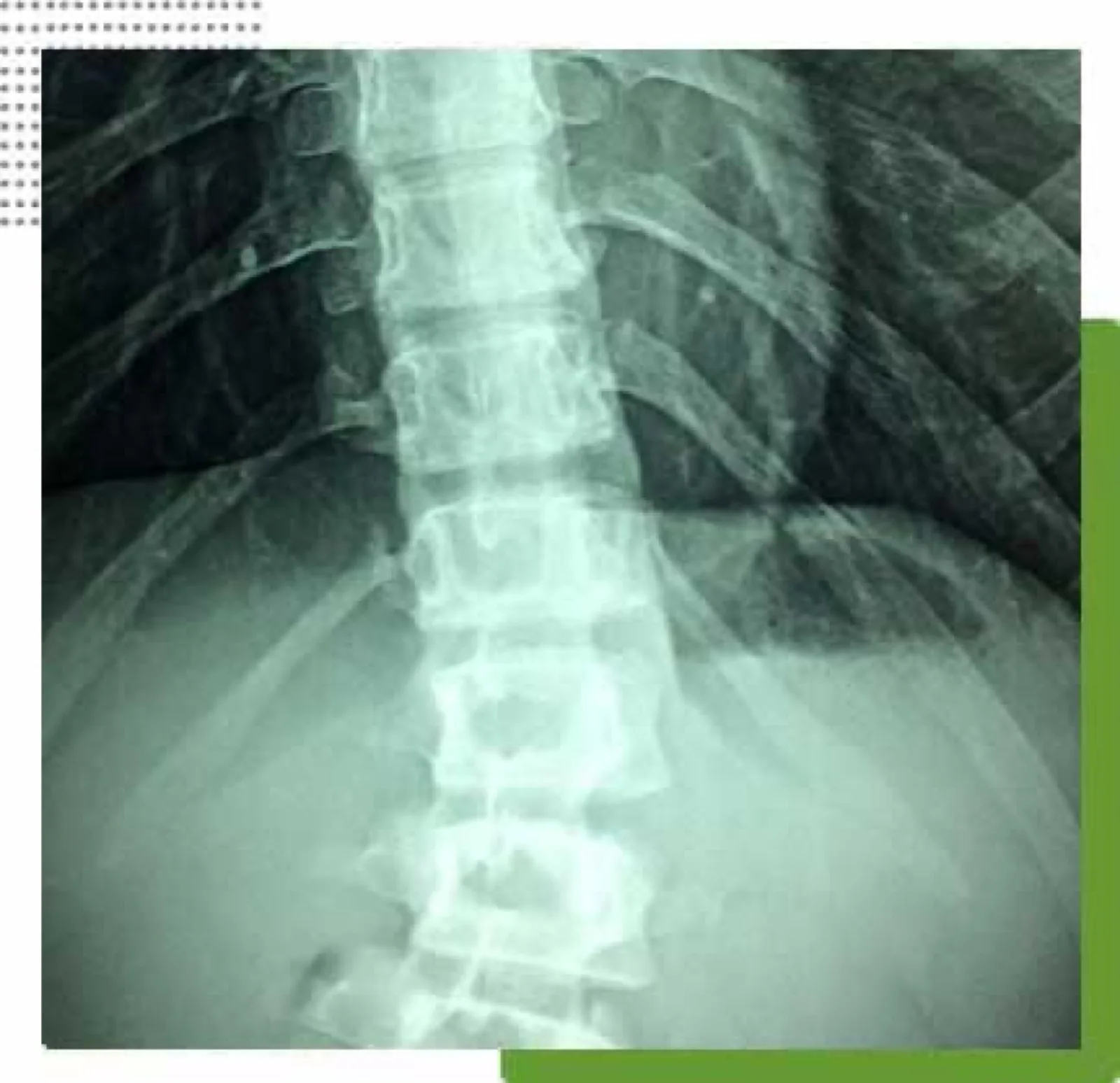 How Often Should I Do Spinal Decompression?