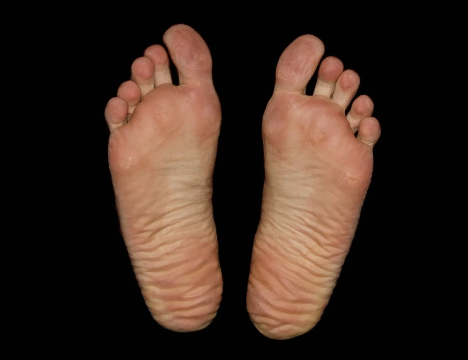 What Can a Chiropractor Do for Plantar Fasciitis?